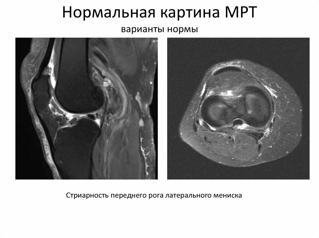 Повреждение мениска на мрт. Латеральный мениск мрт. Мрт разрыв заднего рога мениска.