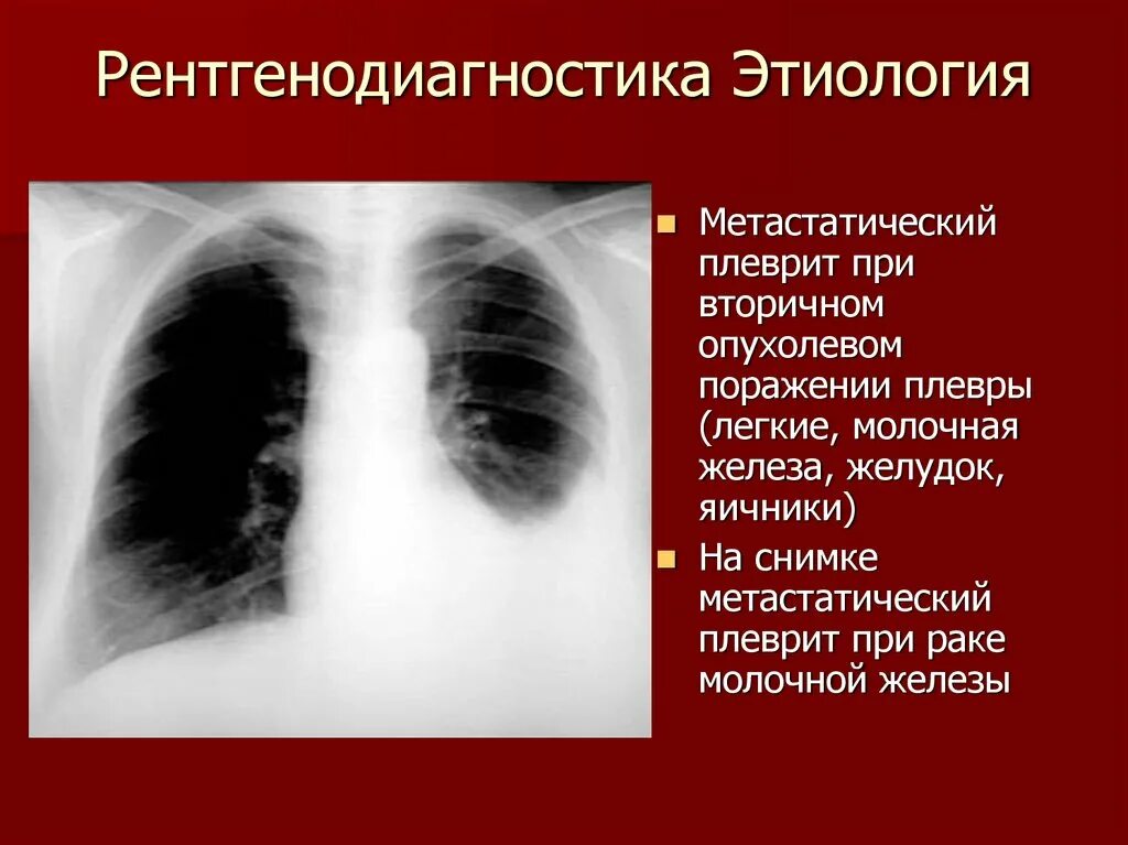 Туберкулезный плеврит рентген. Субтотальный плеврит рентген. Плеврит при пневмонии рентген. Апикальный плеврит рентген. Плевральные осложнения