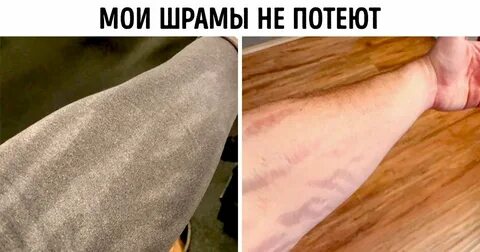 Почему чешусь когда потею