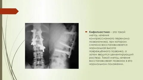 Перелом позвоночника задача