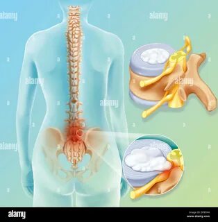 Sciatic hi-res stock photography and images - Alamy