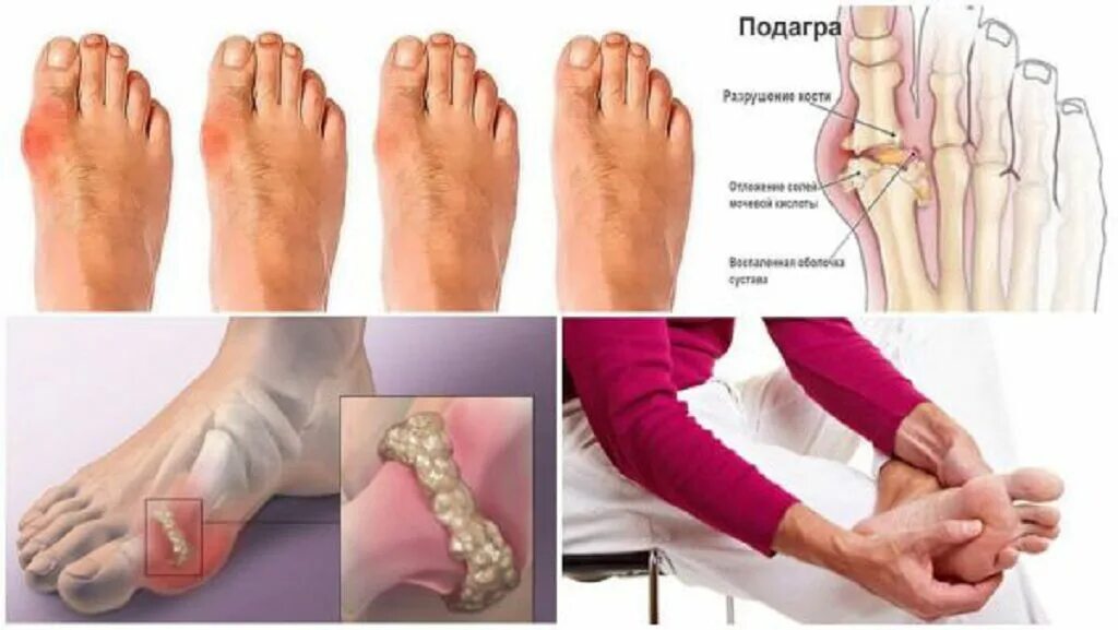 Мочевая кислота повышена суставы. Мочевая кислота повышена суставы