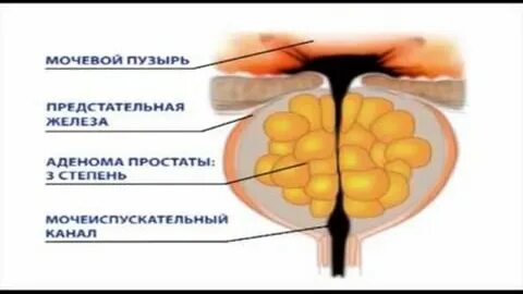 Какие операции при аденоме простаты