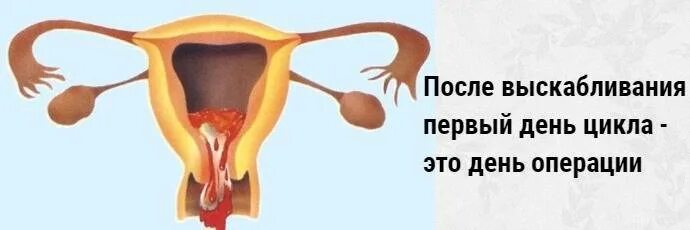 Через сколько месячные после чистки. Месячные после выскабливания матки. Выскабливание замершей беременности. Первые месячные после выскабливания. Выскребание полости матки замершая беременность.