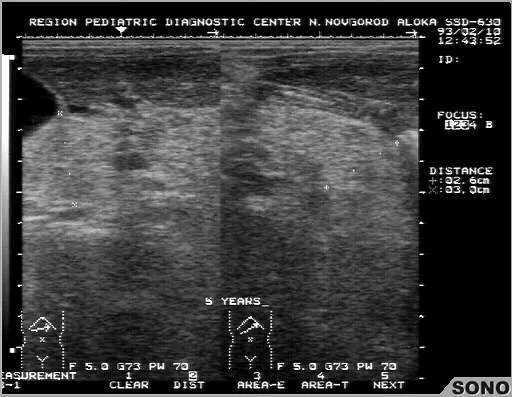Эхоструктура диффузная поджелудочная железа. Фиброз поджелудочной железы на УЗИ. Муковисцидоз поджелудочной железы УЗИ. Кистозный фиброз поджелудочной железы УЗИ. Поджелудочная железа на УЗИ липофиброз.