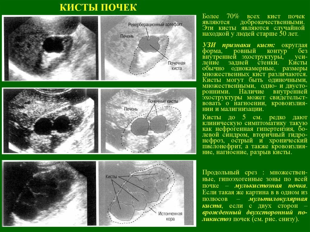 Кисты почек лучевые симптомы. Кисты почечного синуса УЗИ.