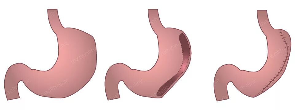 Гастропликация лапароскопическая желудка что это. Ушивание желудка (гастропликация). Как уменьшить желудок без операции