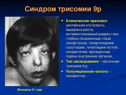 Гипертелоризм