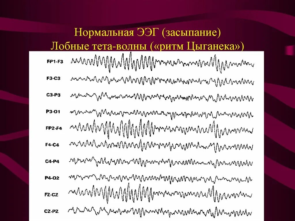 Ээг сигнал. Тета волны на ЭЭГ. Тета ритм ЭЭГ. Бета ритм ЭЭГ. Нормальная ЭЭГ.