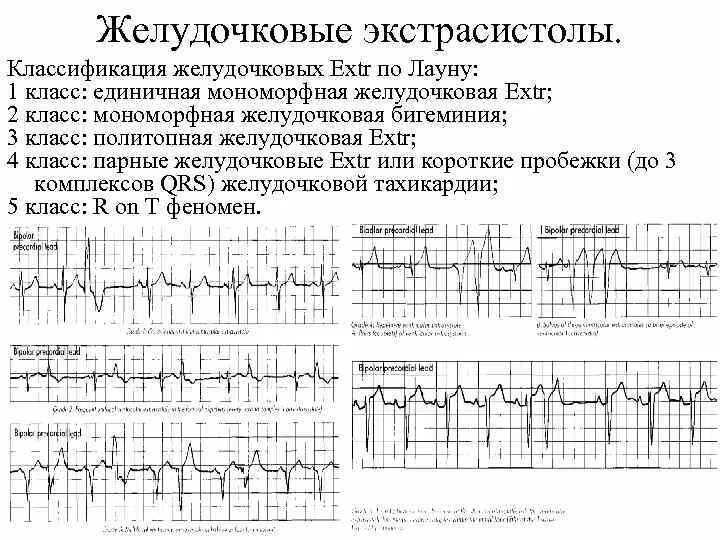 Политопная желудочковая экстрасистолия на ЭКГ. Единичная желудочковая экстрасистолия на ЭКГ. Полиморфная желудочковая экстрасистолия на ЭКГ. Желудочковые мономорфные экстрасистолы ЭКГ. Политопные экстрасистолы