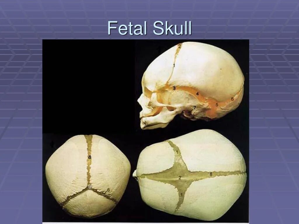 срастание костей черепа. сагиттальный синостоз. расхождение швов черепа у новорожденных. позиционная плагиоцефалия. краниосиностоз свода черепа.