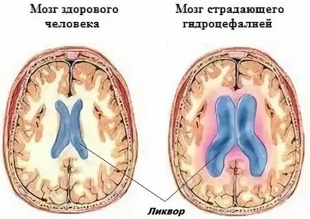 Ребенка внутренняя гидроцефалия