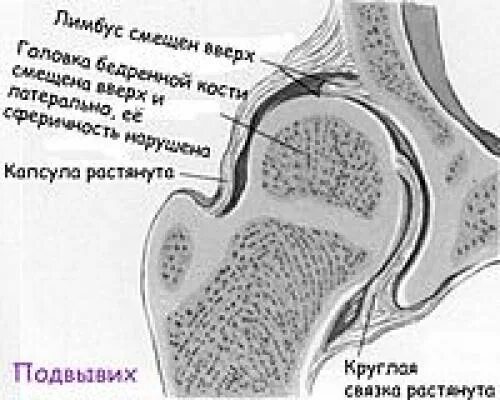 Лимбус тазобедренного сустава это. Лимбус тазобедренного сустава. лимбус вертлужной впадины. лимбус бедренной кости. лимбус сустава расположение.