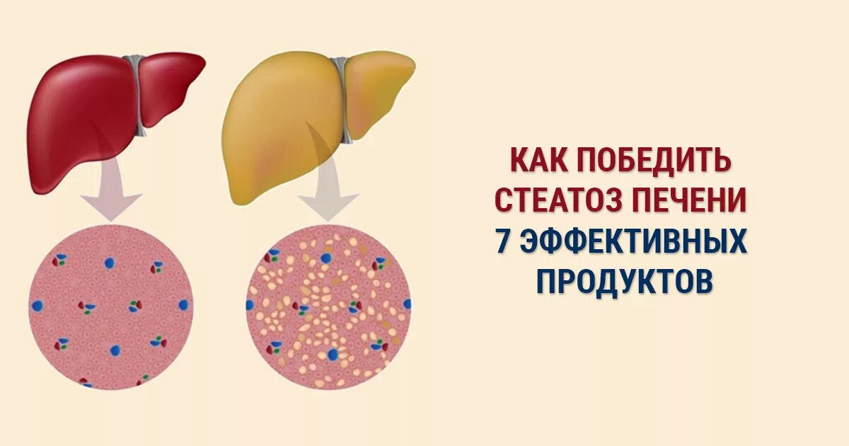 Проявление стеатоза печени. Стадии стеатоза печени.