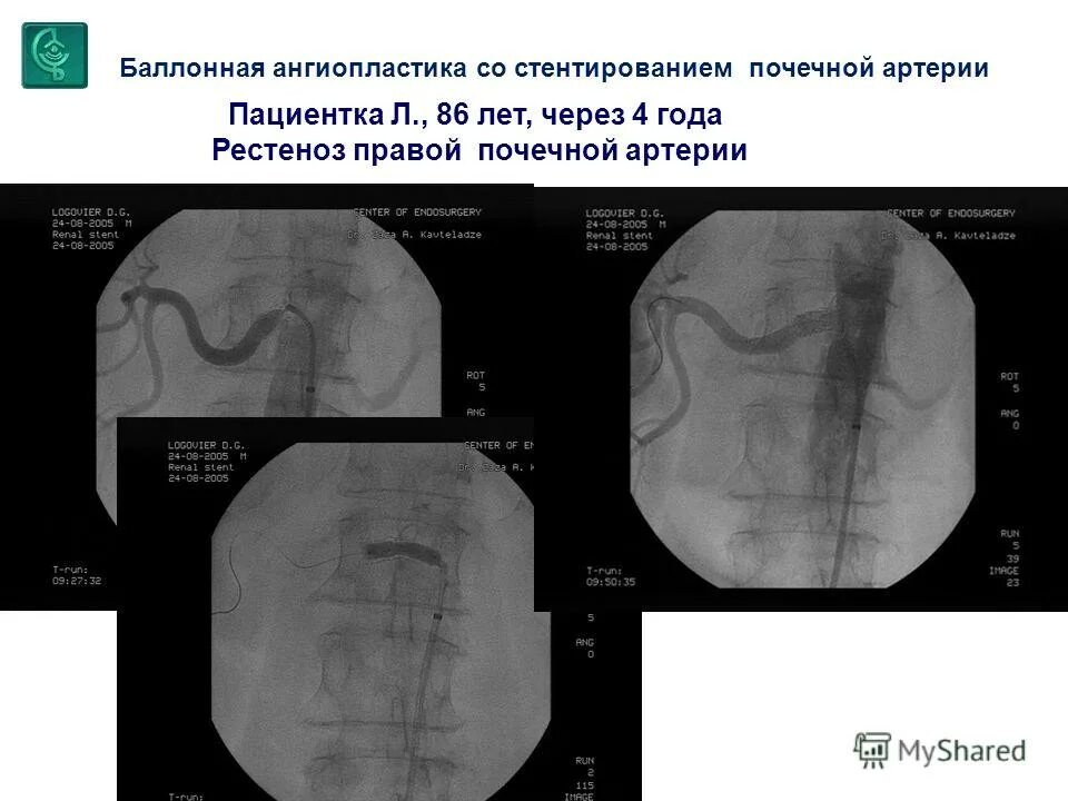 Стентирование сосудов почек. Стентирование почечной артерии. Ангиопластика почечных артерий. Баллонная ангиопластика почечной артерии. Стентирование почечной артерии.