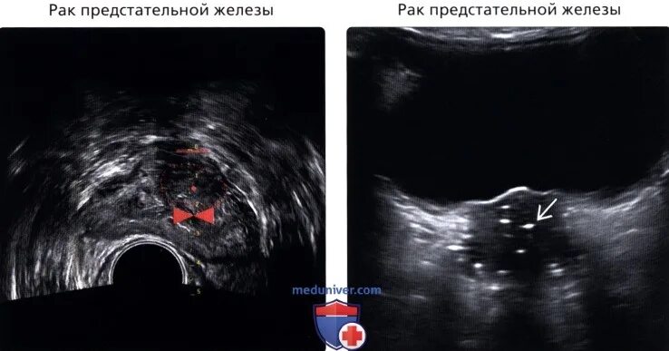 Узел в простате. Узлы предстательной железы на УЗИ. Узлы в предстательной железе УЗИ. Гипоэхогенное образование в предстательной железе. Образования предстательной железы на УЗИ.