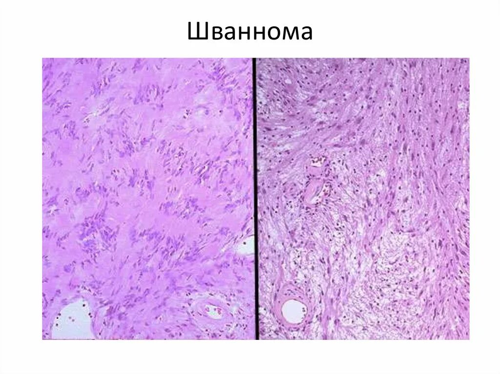 Злокачественная шваннома. Шваннома(неврилеммома). Неврилеммома гистология. Злокачественная шваннома. Тельца верокаи гистология.
