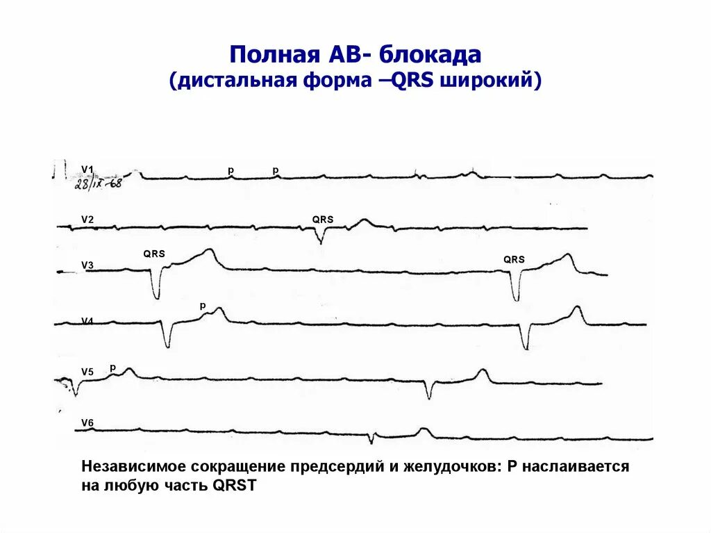 АВ блокада 3 степени дистальный Тип. АВ блокада 3 на ЭКГ. Полная АВ блокада дистальный Тип. ЭКГ. АВ блокада 3 степени проксимальный и дистальный. Fuller av