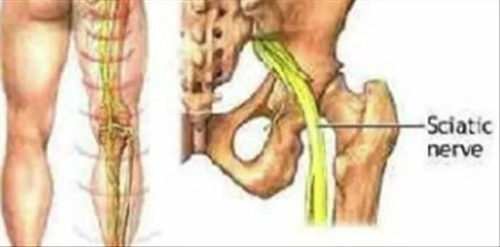 защемление седалищного нерва s1. электростимуляция мышц нижних конечностей. ишиас - защемление седалищного нерва. электромиография (emg). стимуляционная энмг нижних конечностей.