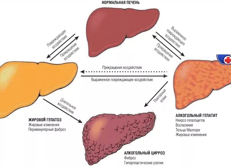 Симптомы лечения печени. Заболевания печени цирроз печени. Синдромы у больных с циррозом печени. Токсический алкогольный цирроз печени. Механизм цирроза печени алкогольного.