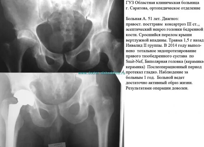 Обследование тазобедренного сустава. Асептический некроз вертлужной впадины. асептический некроз вертлужной впадины тазобедренного сустава мрт. остеонекроз вертлужной впадины кт. вертлужная впадина тазобедренного сустава перелом.