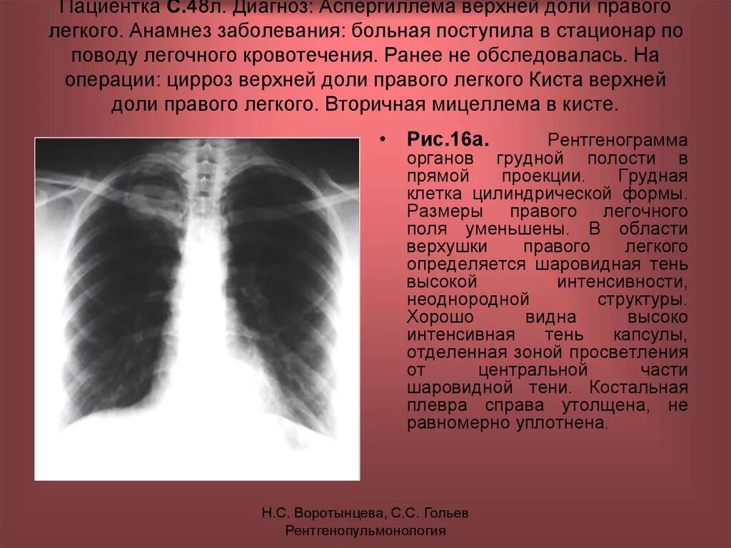 Верхние доли легких тени. Округлая тень в верхней доле правого легкого. Очаговая тень в верхней доле правого легкого. Утолщение костальной плевры. Очаговые тени в легких.