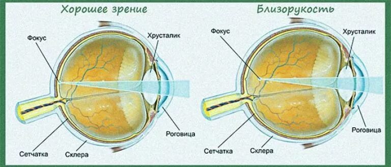 Практическая работа принцип работы хрусталика биология. Строение глаза миопия. Близорукость строение глаза. Структура глаза при близорукости. Анатомия глаза при близорукости.