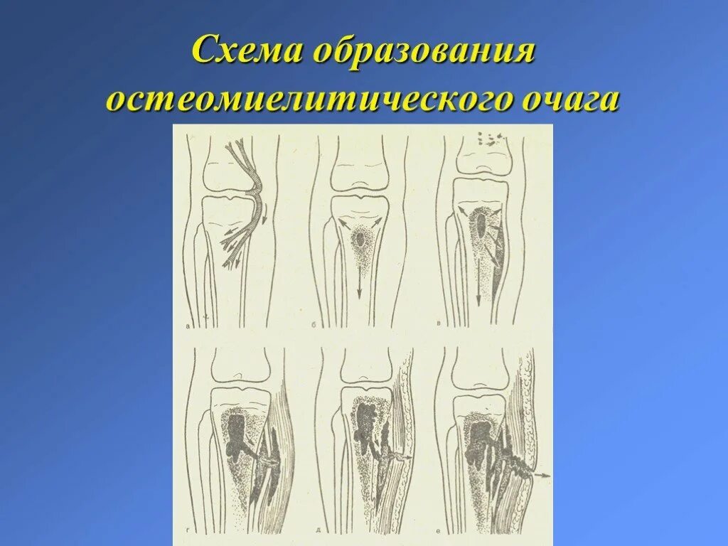 Гнойные заболевания суставов. Формирование остеомиелитического очага. Гнойные заболевания костей и суставов. Гнойно воспалительные заболевания костей. Гнойные заболевания костей презентация.