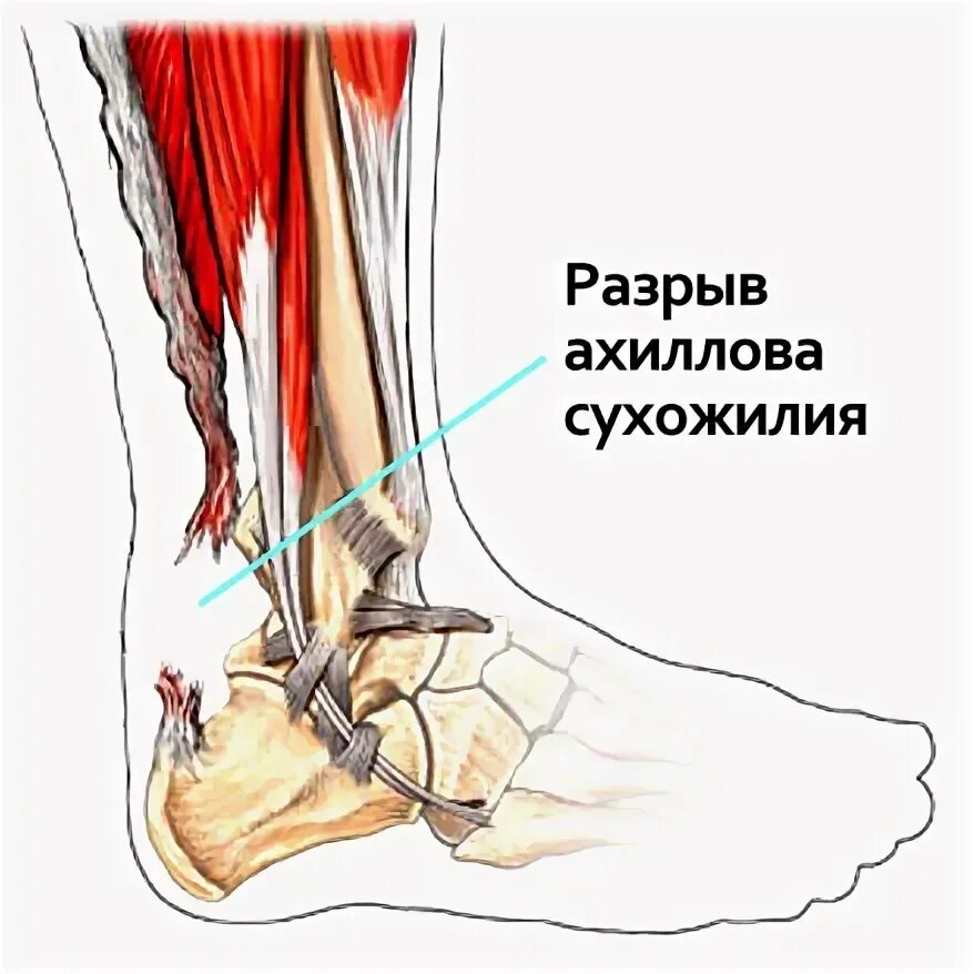 Сколько заживает сухожилие. Разрыв связок ахиллова сухожилия. Разрыв связок ахиллова сухожилия симптомы. Разрыв ахиллова сухожилия операция. Подкожный разрыв ахиллова сухожилия.
