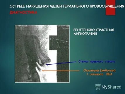 Стеноз чревного ствола