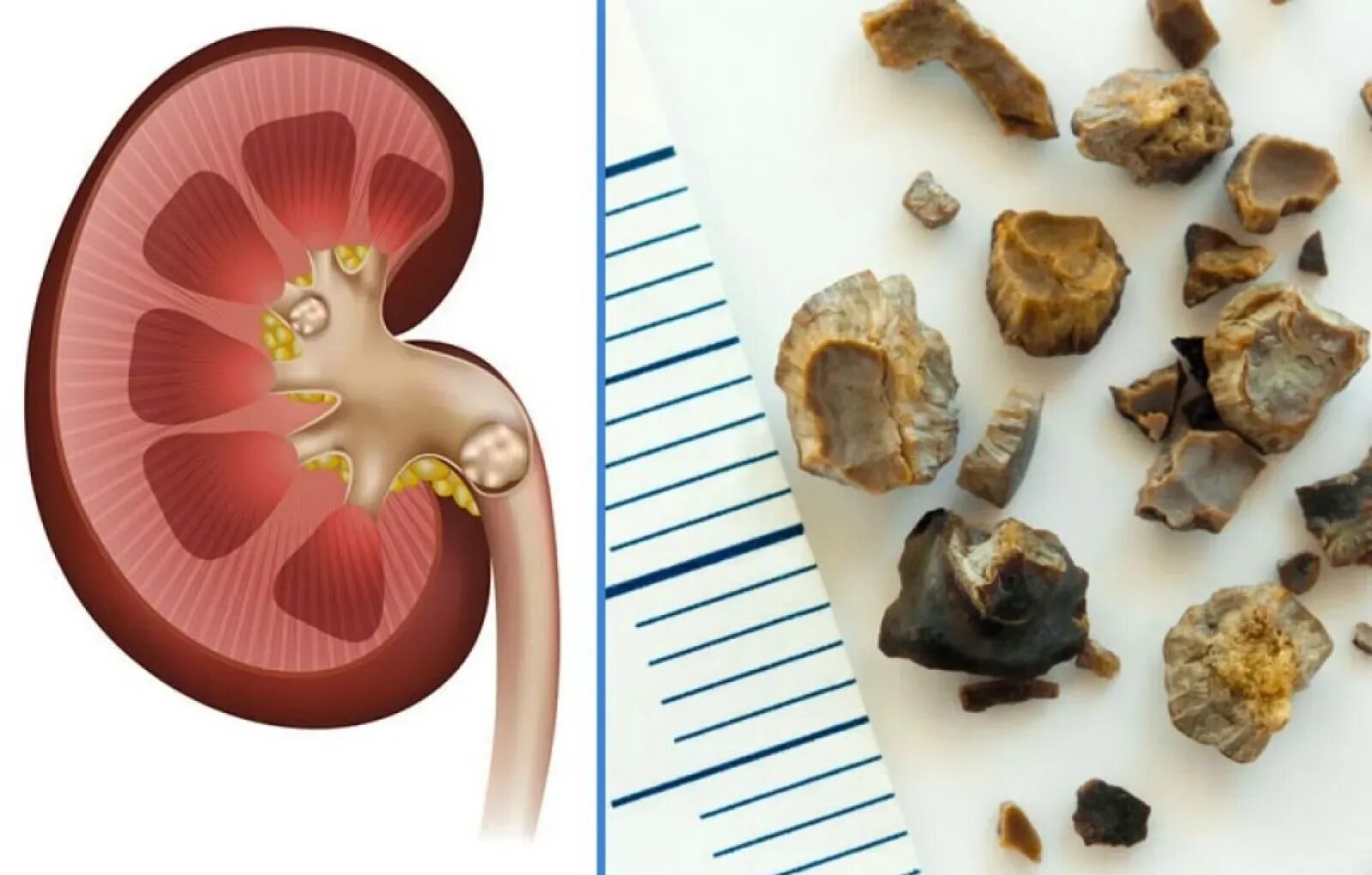 Выходит камень симптомы у мужчин. Коралловидный нефролитиаз. Мочекаменная болезнь цистиновые камни.
