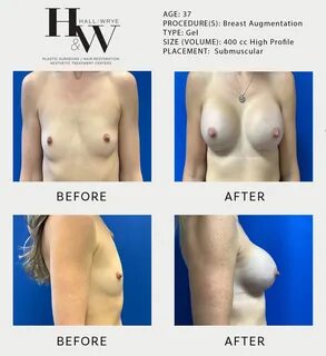A breast augmentation can increase breast... 