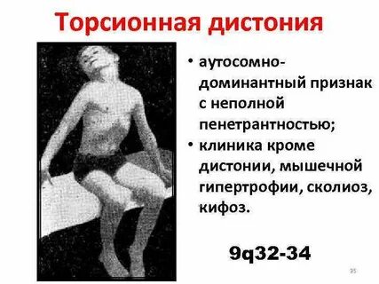 Мышечная дистония
