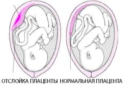 Отслойка поздние сроки