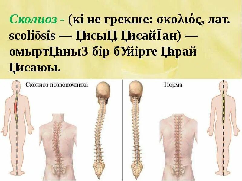 Сколиоз последней степени. Скелет человека сколиоз позвоночника.