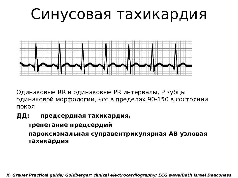 Сердцебиение при незначительной физической нагрузке. ЭКГ при синусовой тахикардии. ЭКГ синусовая тахикардия пленка. Синусовая тахикардия ЭКГ расшифровка. Признаками синусовой тахикардии на ЭКГ являются.