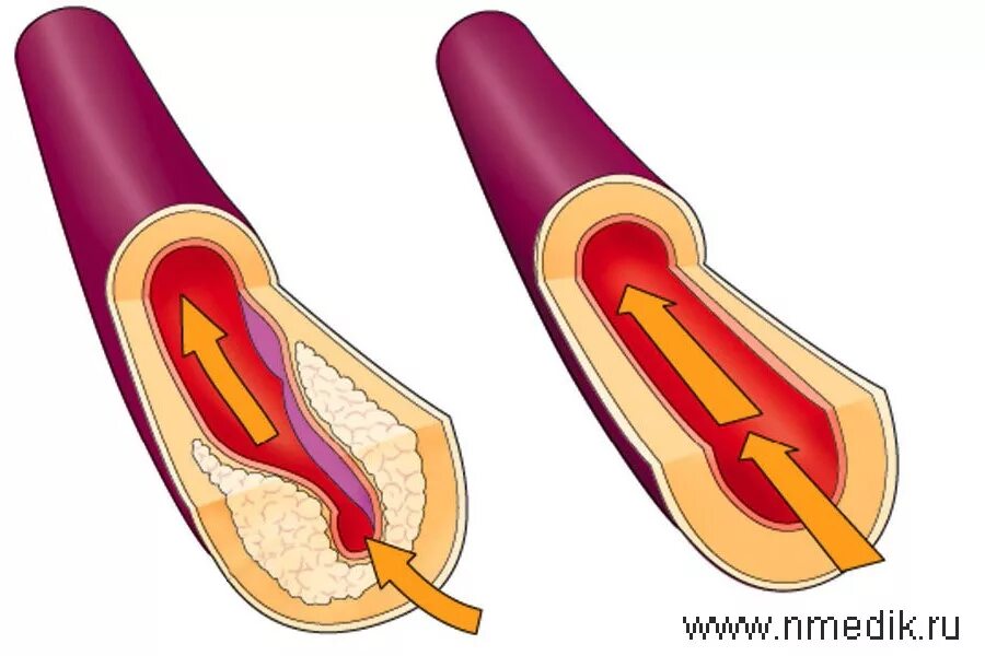 От бляшек и тромбов как очистить. Атеросклероз (закупорка кровеносных сосудов).