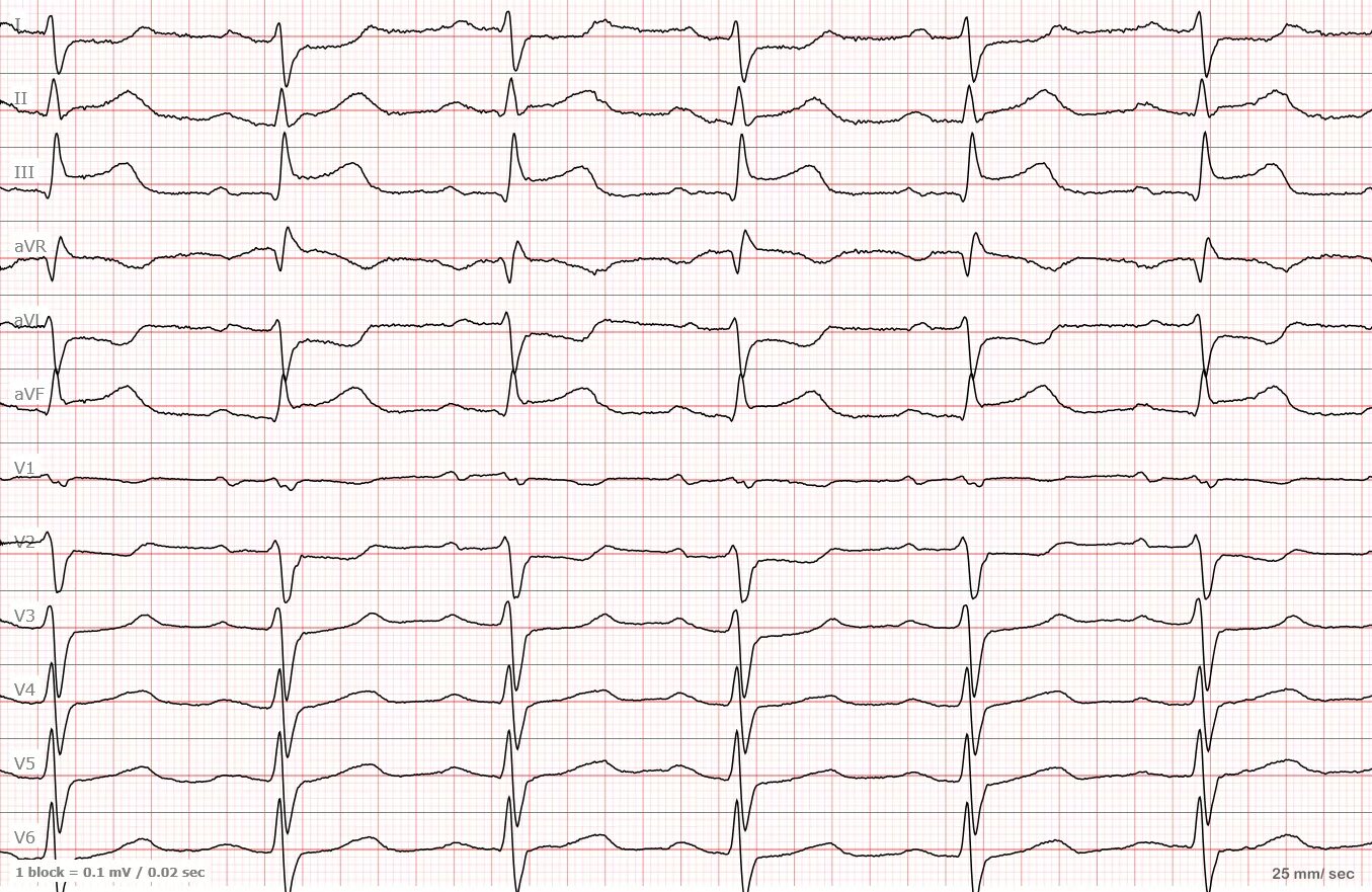 Инфаркт с подъемом сегмента St ЭКГ. ЭКГ при инфаркте без подъема St. Элевация сегмента St на ЭКГ. Сегмент St на ЭКГ при инфаркте миокарда.