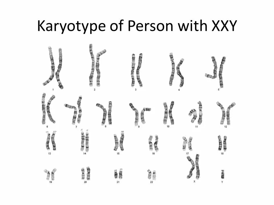 Xxy хромосома. Синдром Клайнфельтера схема. Синдром Клайнфельтера люди. Кариотип Клайнфельтера. Набор хромосом при синдроме Клайнфельтера.