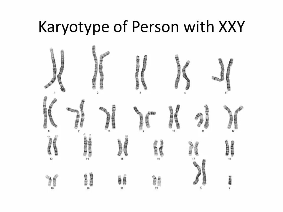 Синдром Клайнфельтера схема. Синдром Клайнфельтера люди. Кариотип Клайнфельтера. Набор хромосом при синдроме Клайнфельтера.
