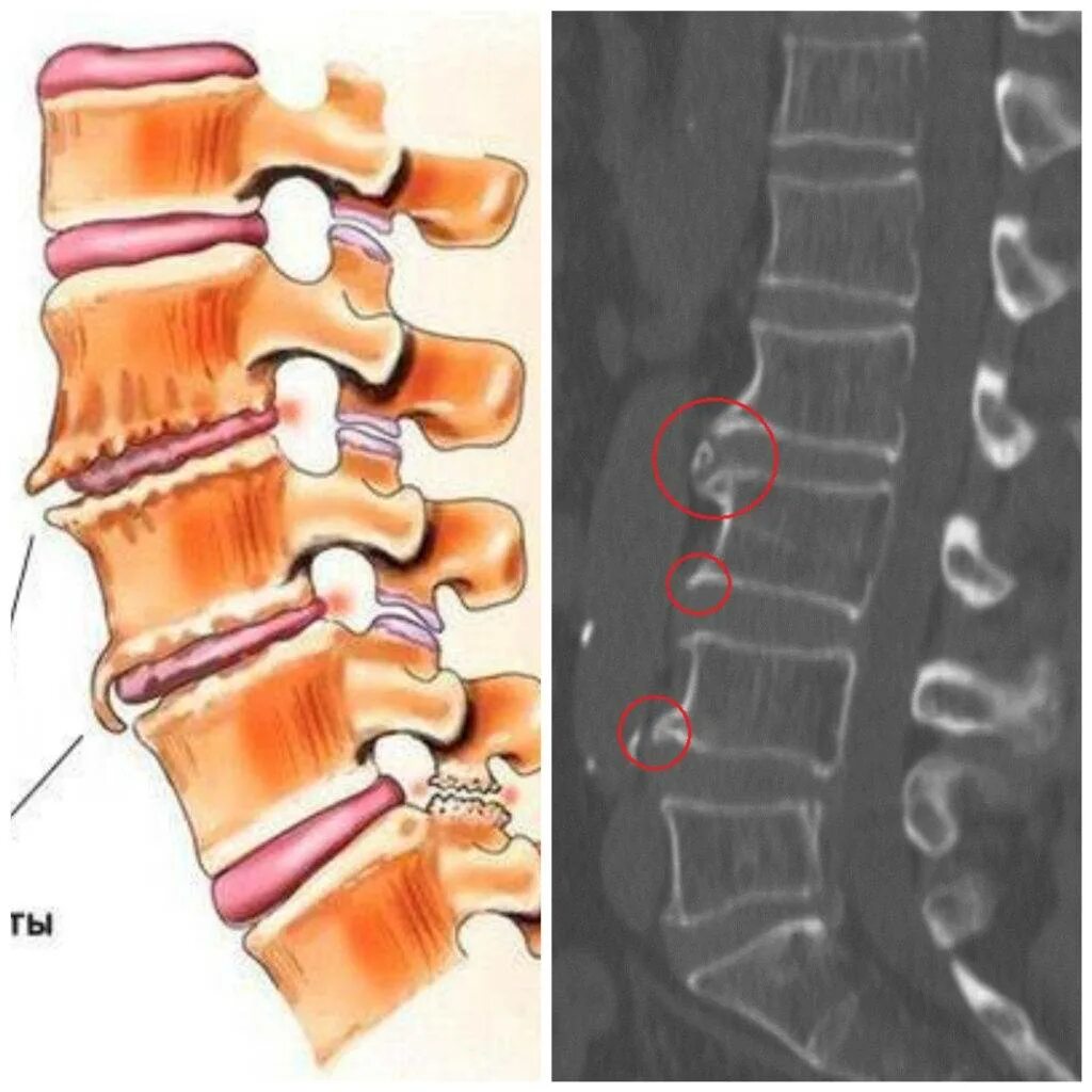 Межпозвонковый артроз l3-s1. Спондилоартроз l2-s1 что это такое. Спондилез с4- с6. Спондилез l1-l2 сегмента. Картина спондилеза