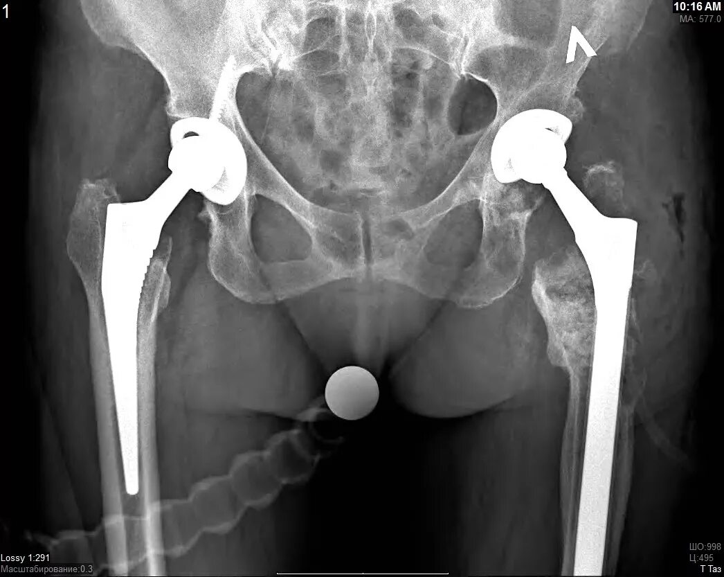 Эндопротезирование ТБС. Эндопротез ТБС рентген. Ревизия ТБС эндопротеза. Тазобедренный эндопротез Зиммер.