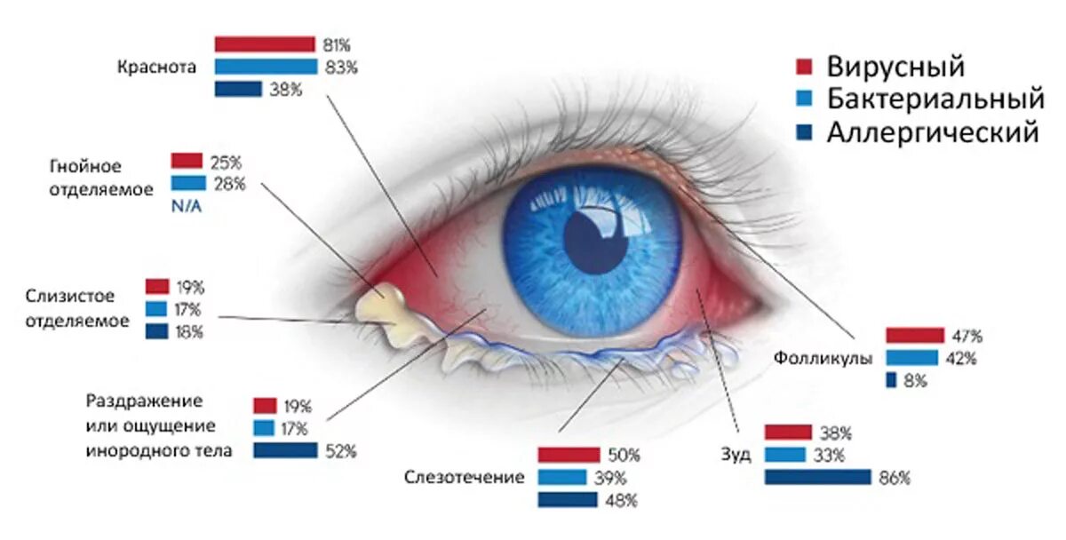 Вирусный аллергический конъюнктивит лечение. Отличие вирусного и бактериального конъюнктивита. Конъюнктивит виды как отличить. Симптомы бактериального вирусного аллергического конъюнктивита.