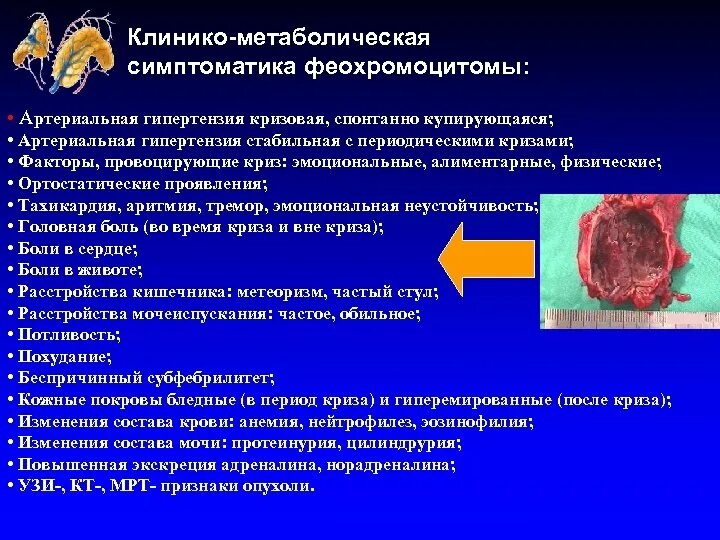Криз при феохромоцитоме