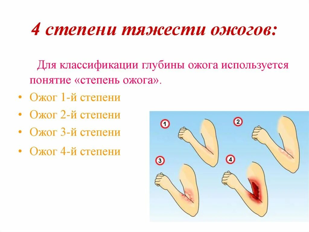 3 й стадии. Ожоги 1 степень 2 степень 3 степень 4 степень. Ожог 2 степени степень тяжести. Ожог 4 степени степень тяжести.