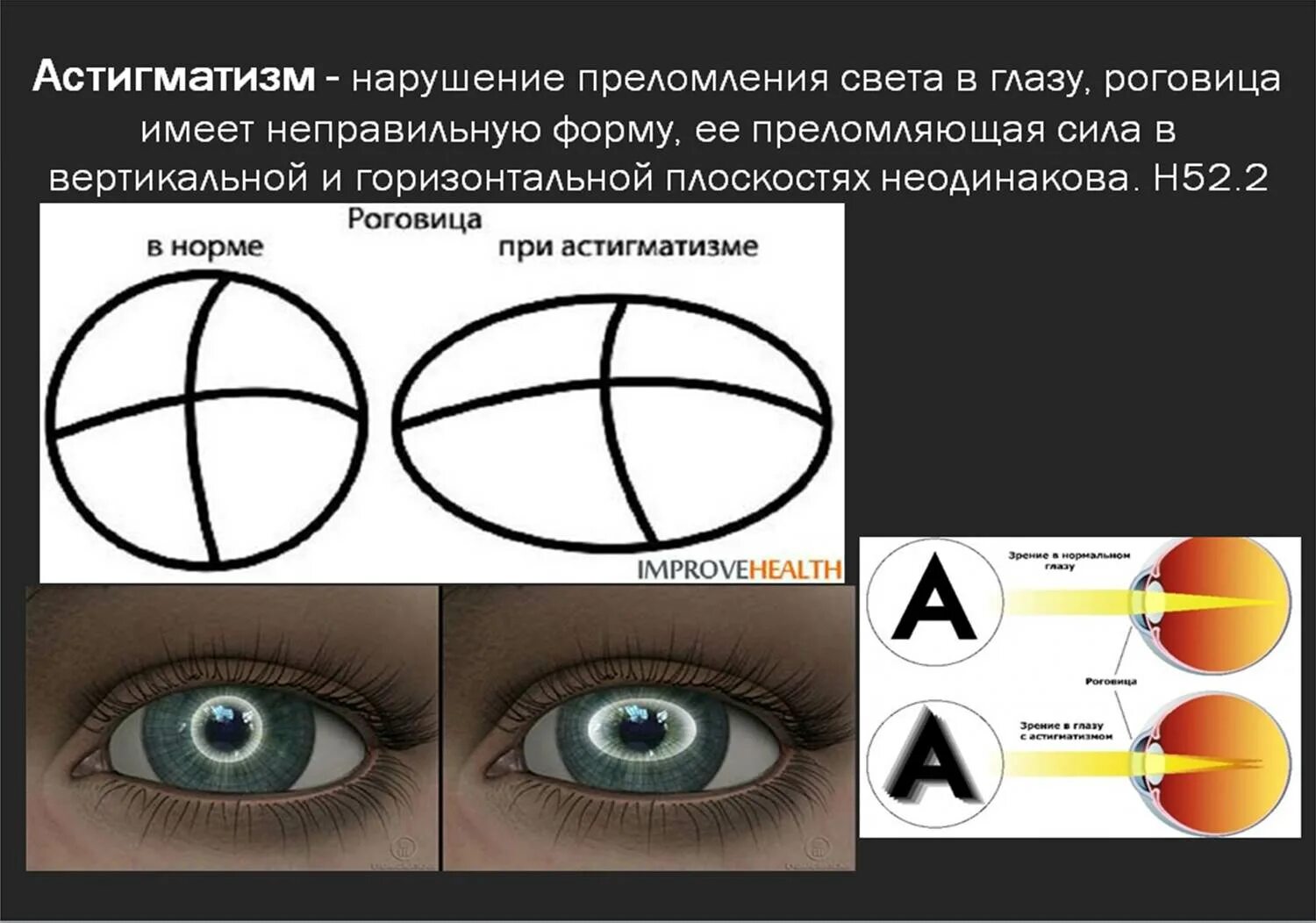 Миопия дальнозоркость астигматизм. Косоглазие обоих глаз. Очки для коррекции миопии. Сложный близорукий астигматизм. Болезнь глаз астигматизм.