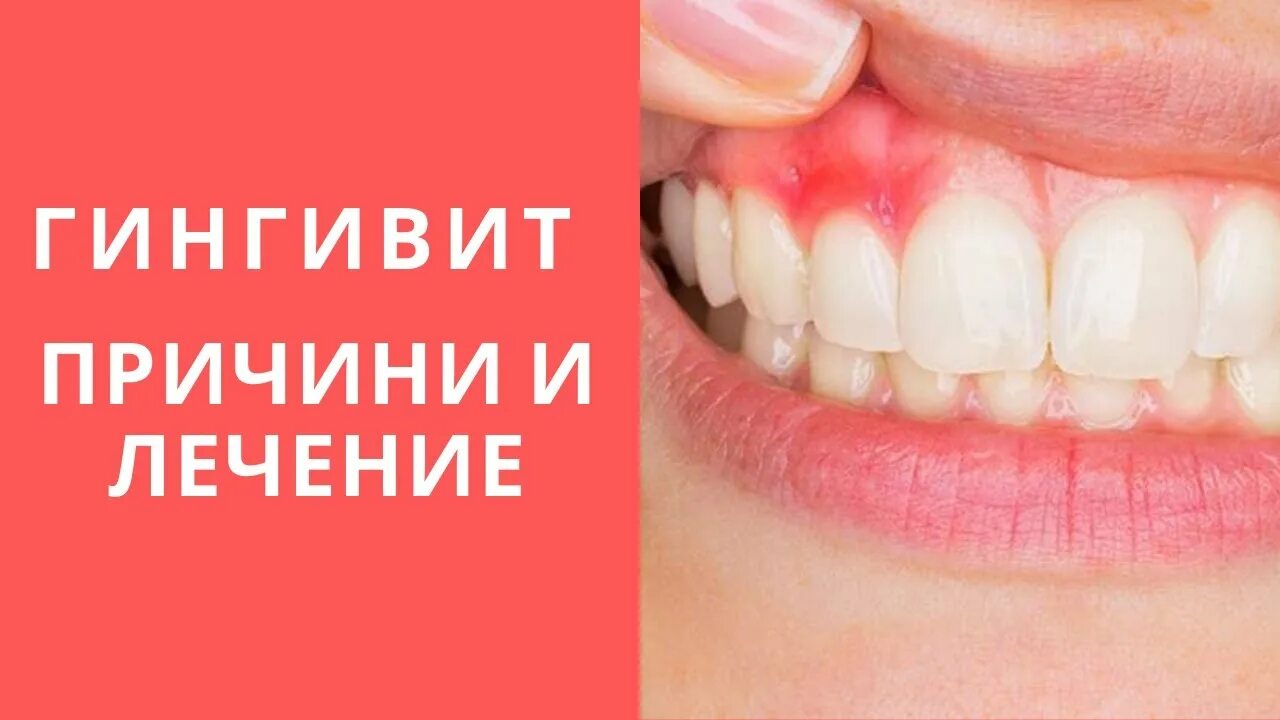 Гингивит представляет собой воспалительное заболевание десен, которое происходит