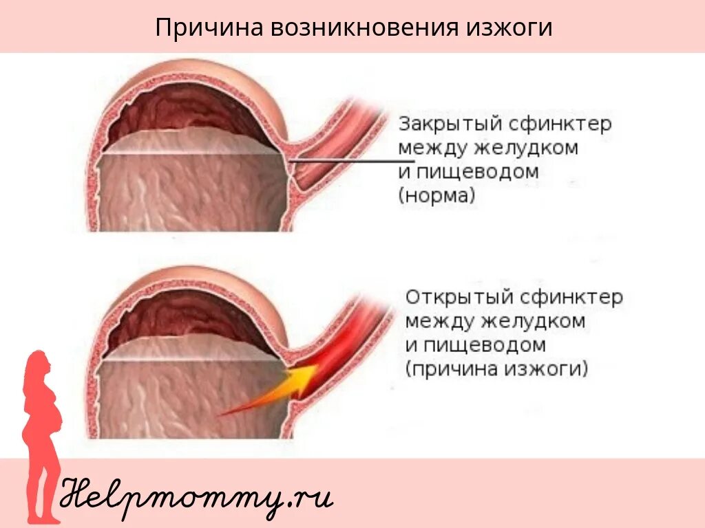 Между пищеводом и желудком. Изжога причины. Причины возникновения изжоги. Клапан между желудком и пищеводом. Почему сфинктер