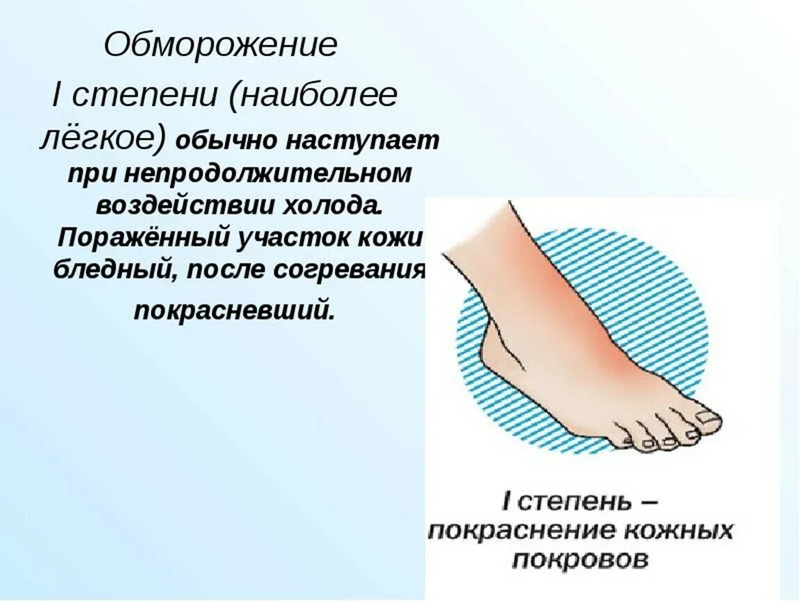 Отморожение 1 степени помощь. Обморожение кожи первая степень. обморожение презентация. презентация на тему отморожение. легкое обморожение кожи.