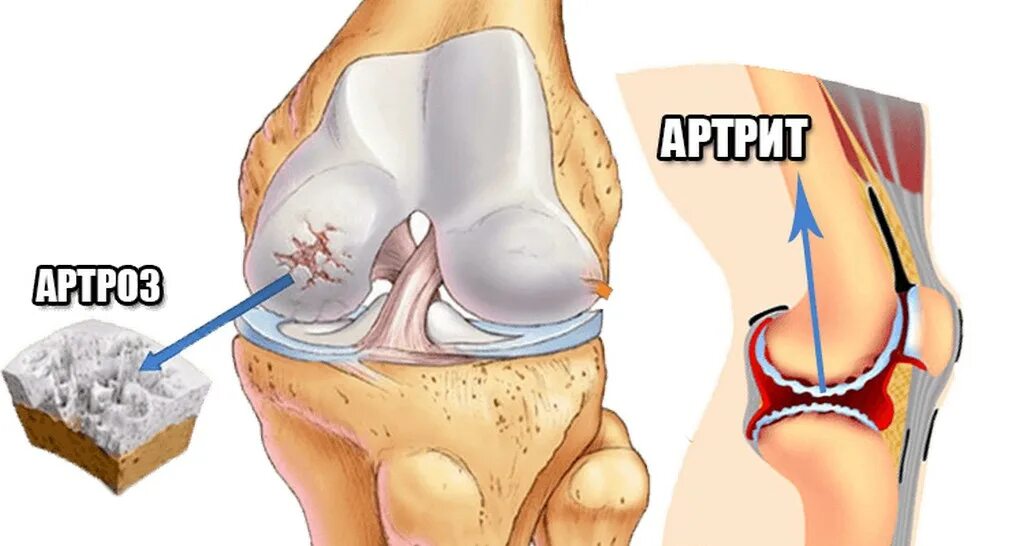 Остеоартроз и артрит разница. Артрит сустава что делать